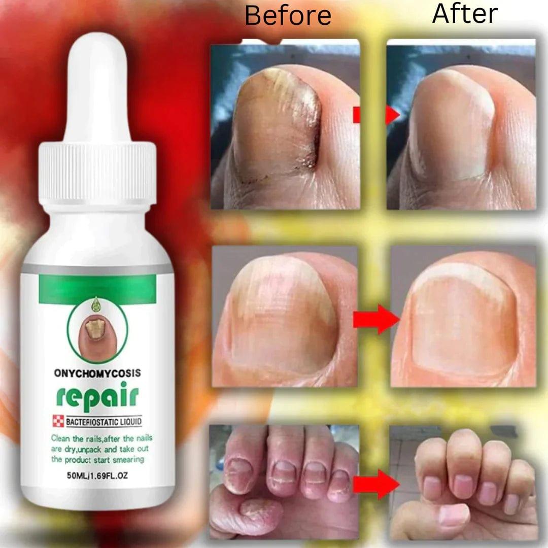 NAILS SERUM FOR NAIL GROWTH & REPAIR, FUNGAL INFECTION, ANTI-INFECTIVE REMOVAL PARONYCHIA ONYCHOMYCOSIS